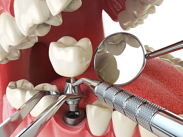Best Emergency Root Canal Therapy in Buffalo Center, IA
